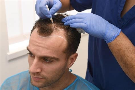 Cost of hair transplant in turkey with blue magic hair